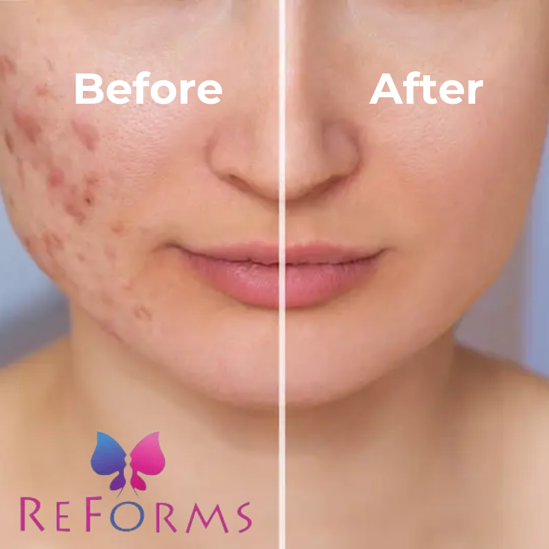 Best Acne Scar Treatment in Noida