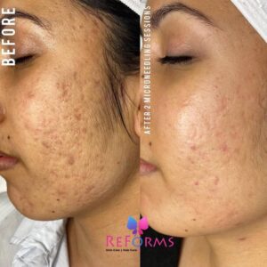 Acne Scars Before and After