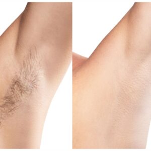 Before and After Results of Laser Hair Removal
