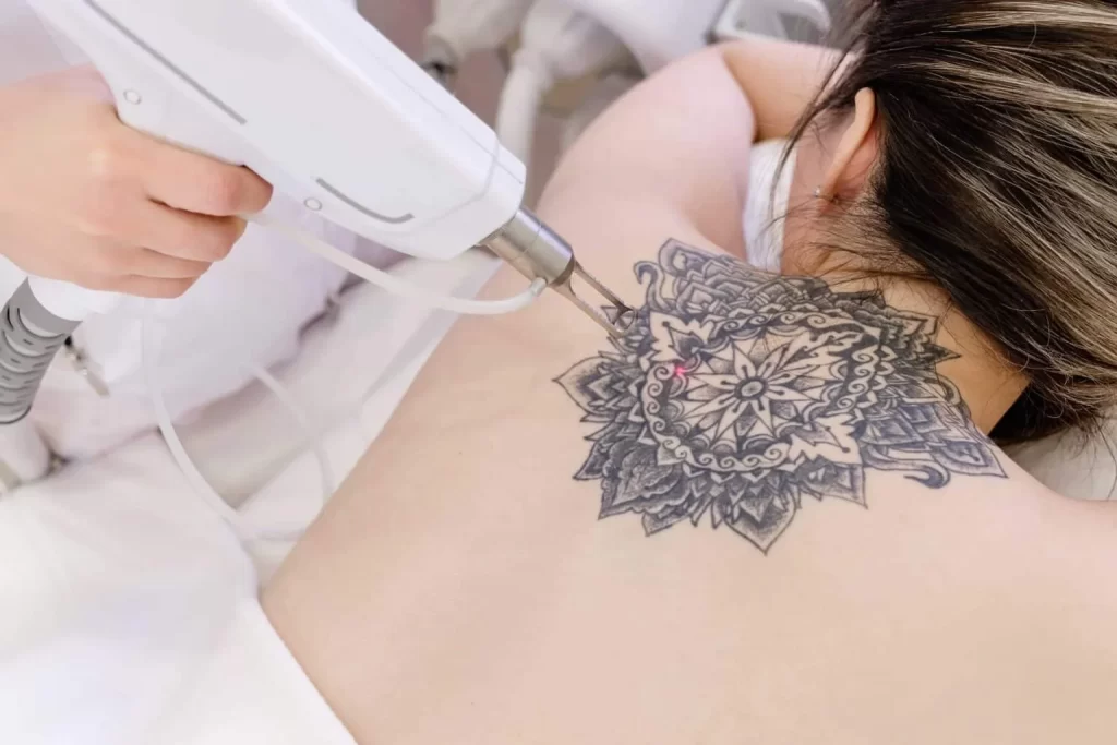 Tattoo Removal Cost Near Me