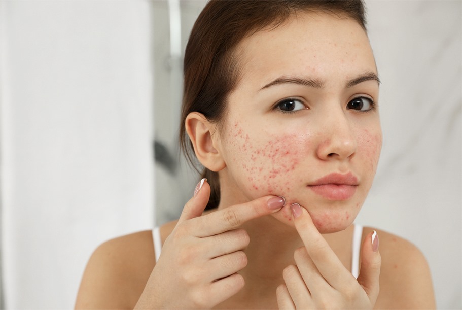 Best Acne Scar Removal Treatments for the Face