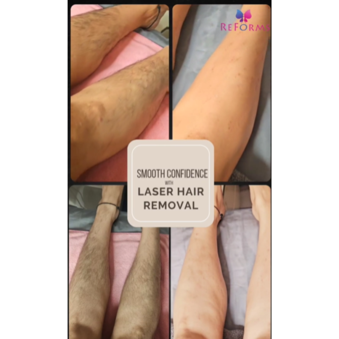 smooth skin revolution with laser hair removal